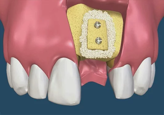 Technique régénérative