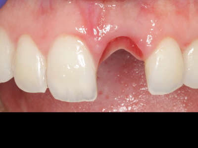 Les implants post-extraction immédiats et le chargement immédiat.  Gestion des tissus mous autour des implants