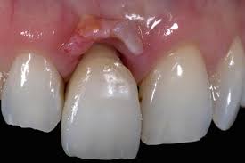Les implants post-extraction immédiats et le chargement immédiat. Gestion des tissus mous autour des implants