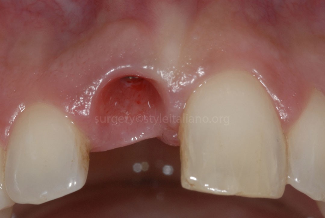 Les implants post-extraction immédiats et le chargement immédiat. Gestion des tissus mous autour des implants
