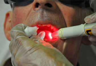 Le laser en implantologie