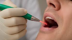 Le laser en implantologie