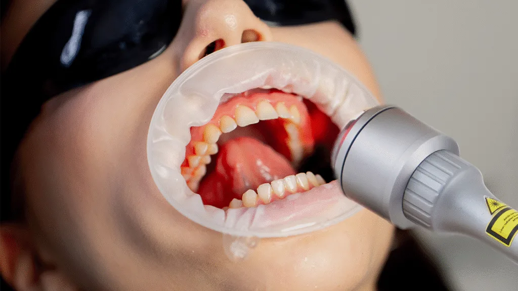 Intégration de la dentisterie esthétique et cosmétique du visage: Botox et produits de comblement dermique (THEORIE + WORKSHOP) + LASER DENTAIRE