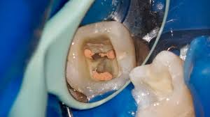 Full immersion in modern endodontics — image 1