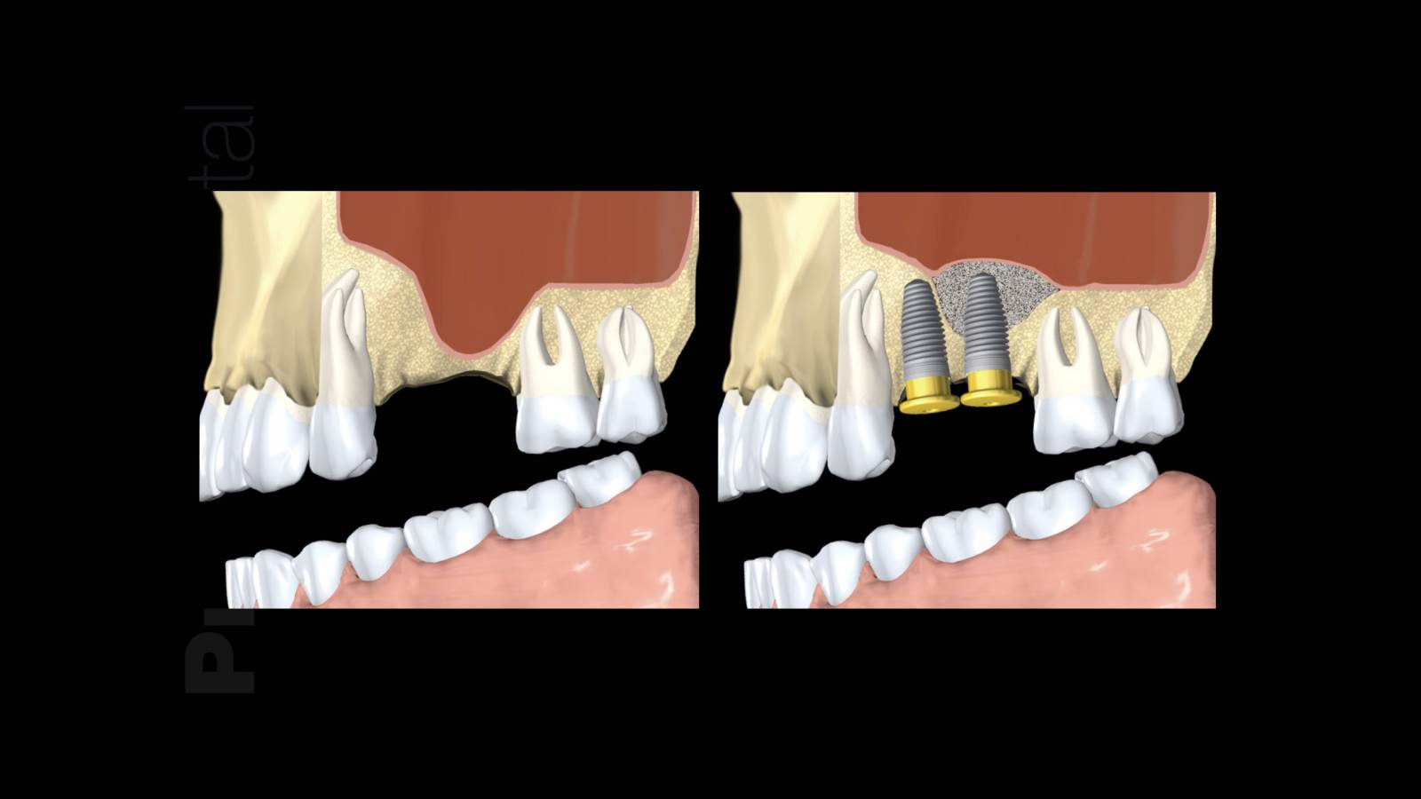 Sinus Lift : protocoles chirurgicaux d’ouverture et de fermeture du sinus maxillaire