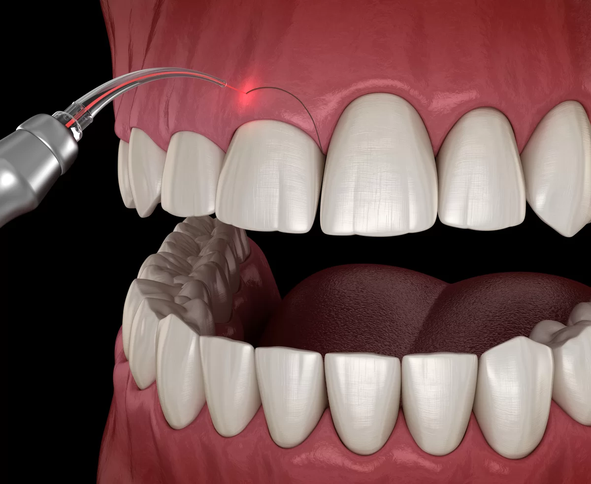 Le laser en parodontologie (Soins esthétiques et thérapeutiques des gencives)