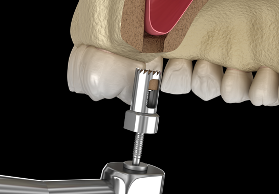 Technique de greffe de Sinus Lift par ouverture et fermeture (Copie) — image 1