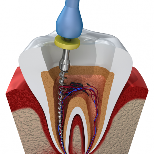 Les Fondamentaux de l’Endodontie Clinique : Accès, Mise en Forme et Obturation  (Théorie et pratique)